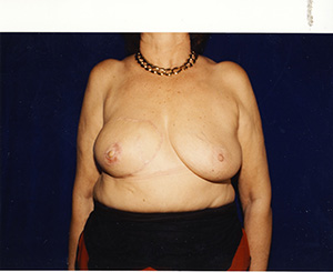 Breast Reconstruction 2b
